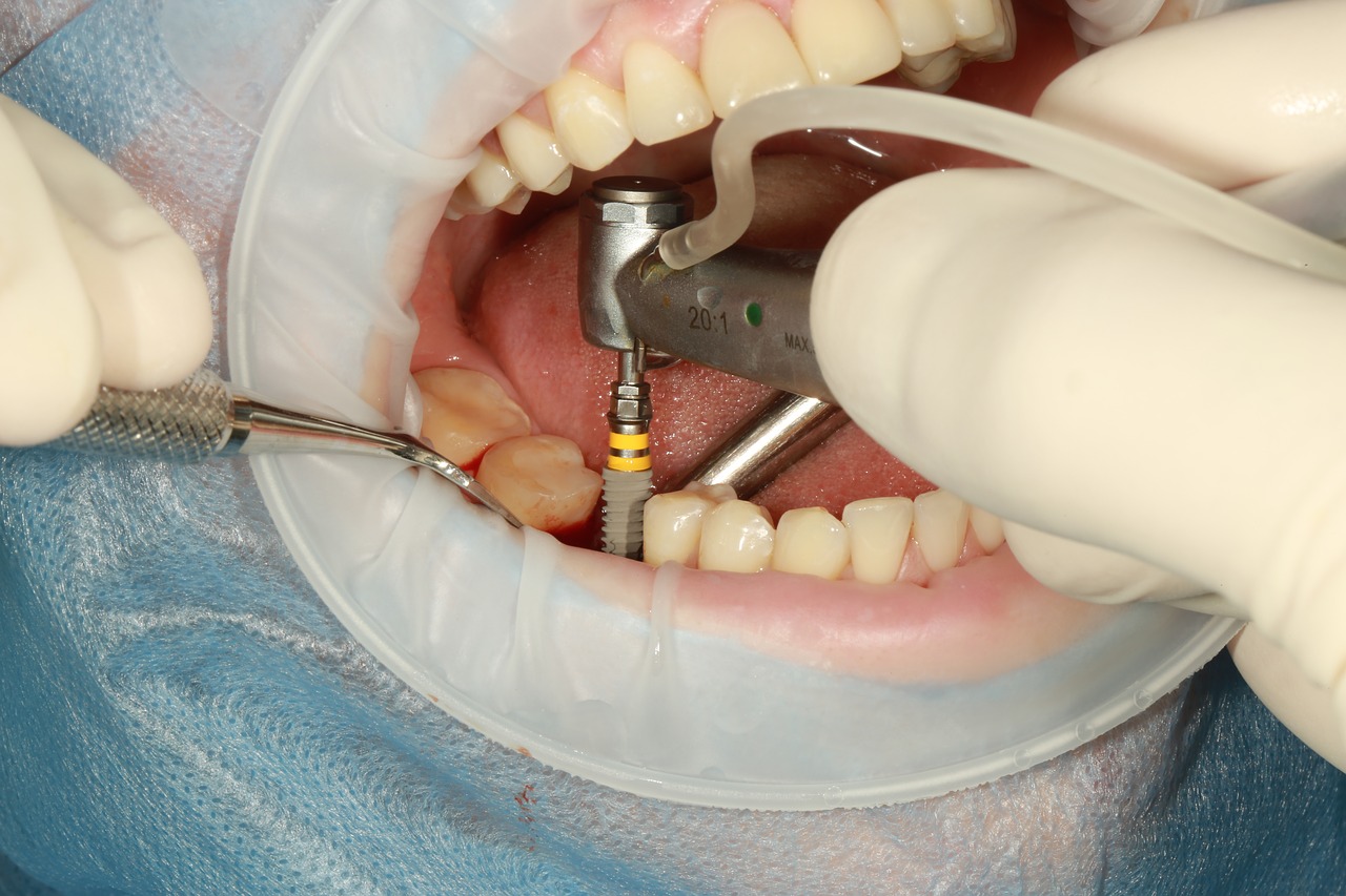 Implant dentaire : quels sont ses principaux avantages ?